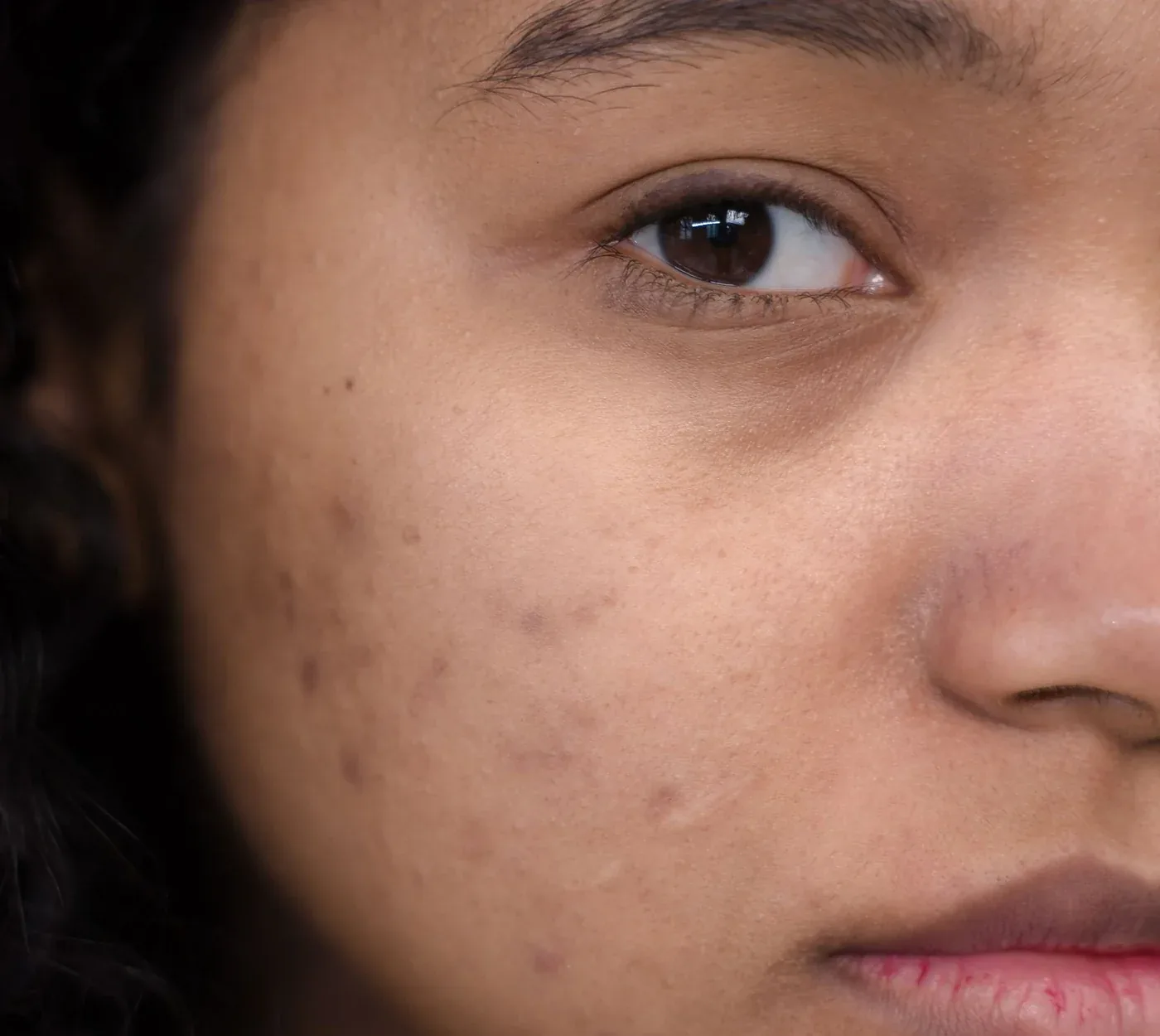 Close-up of acne scars and uneven texture on a woman’s cheek