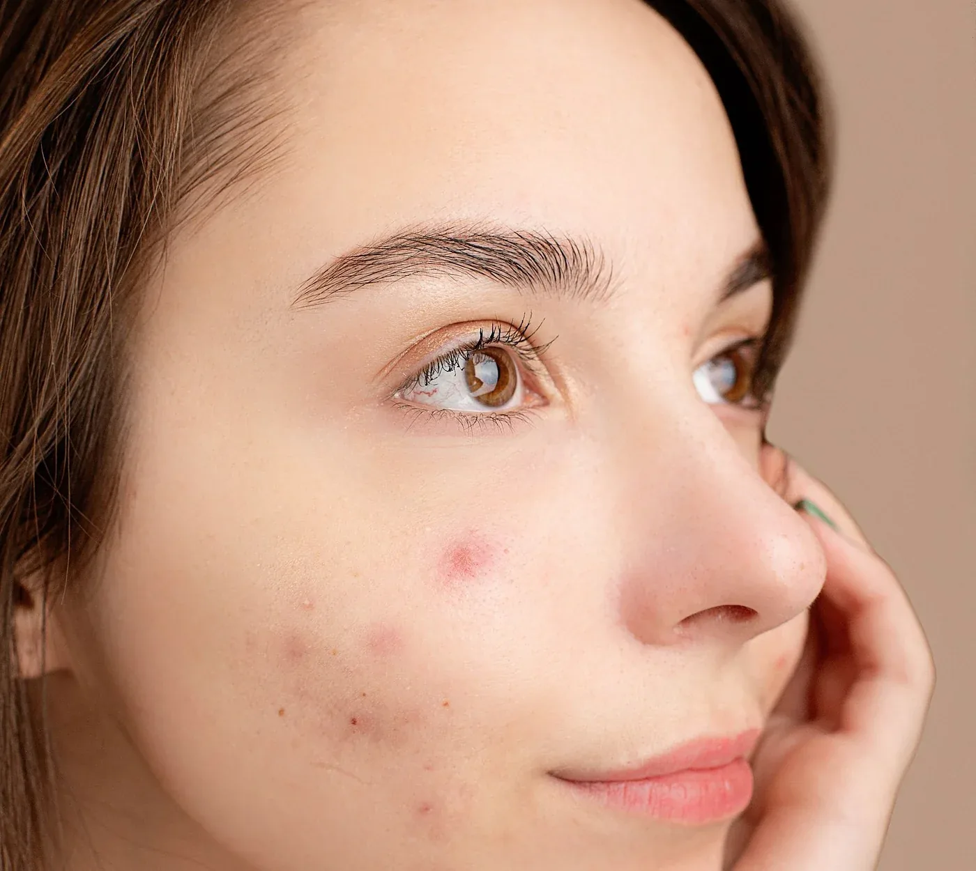 Young woman with acne spots on her cheek