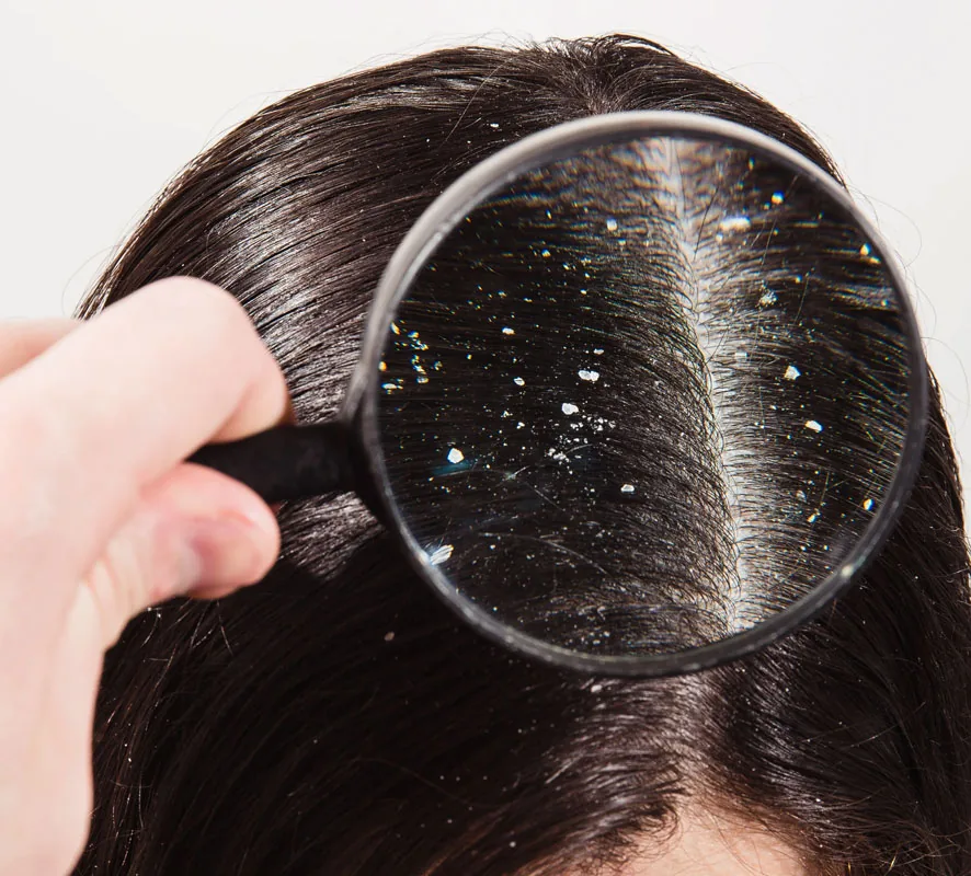 Magnifying glass showing dandruff flakes along a hair parting