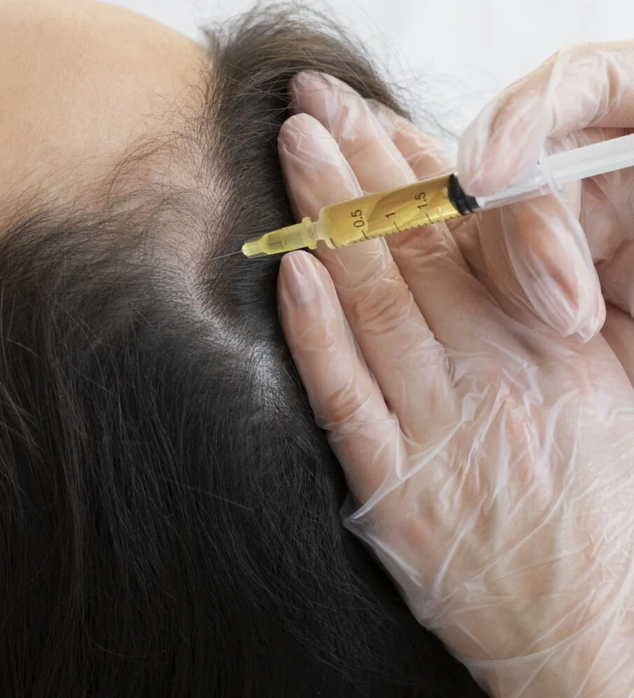 Growth factor concentrate injected into a thinning scalp