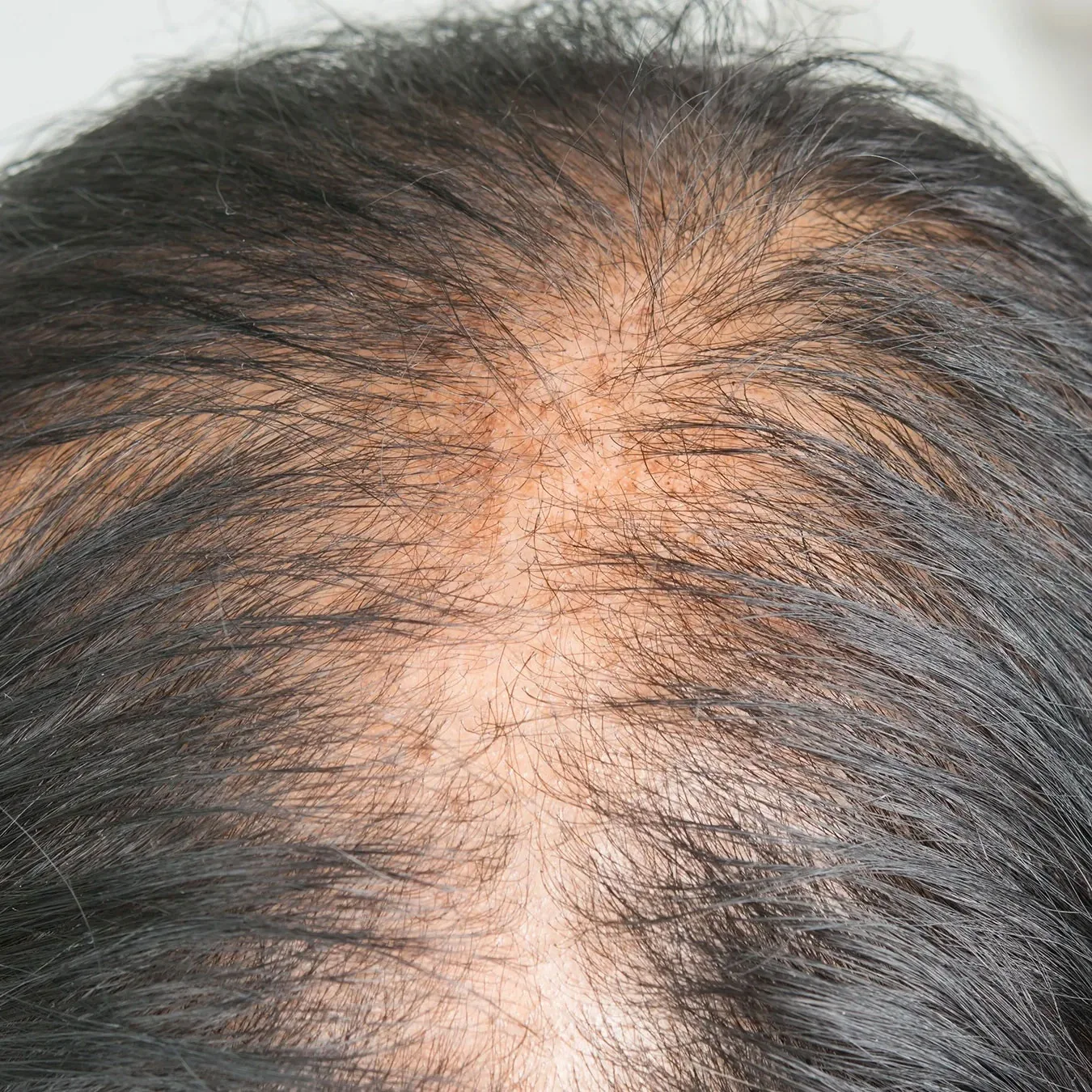 Top view of thinning hair at the crown suitable for a hair patch