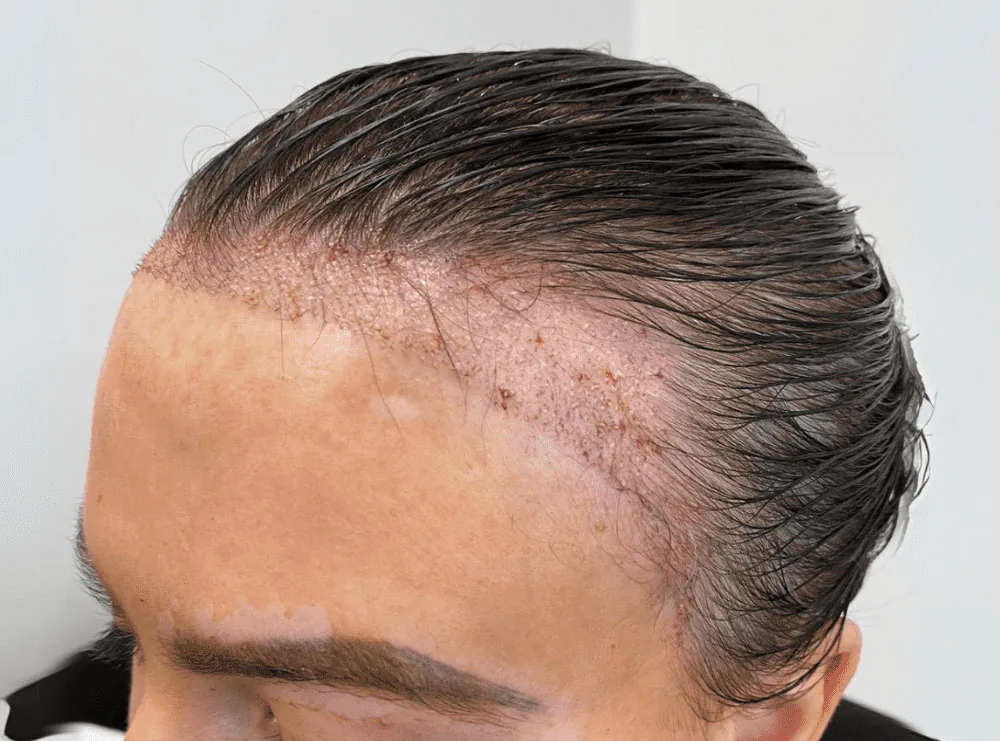 Restored hairline after a hair transplant procedure