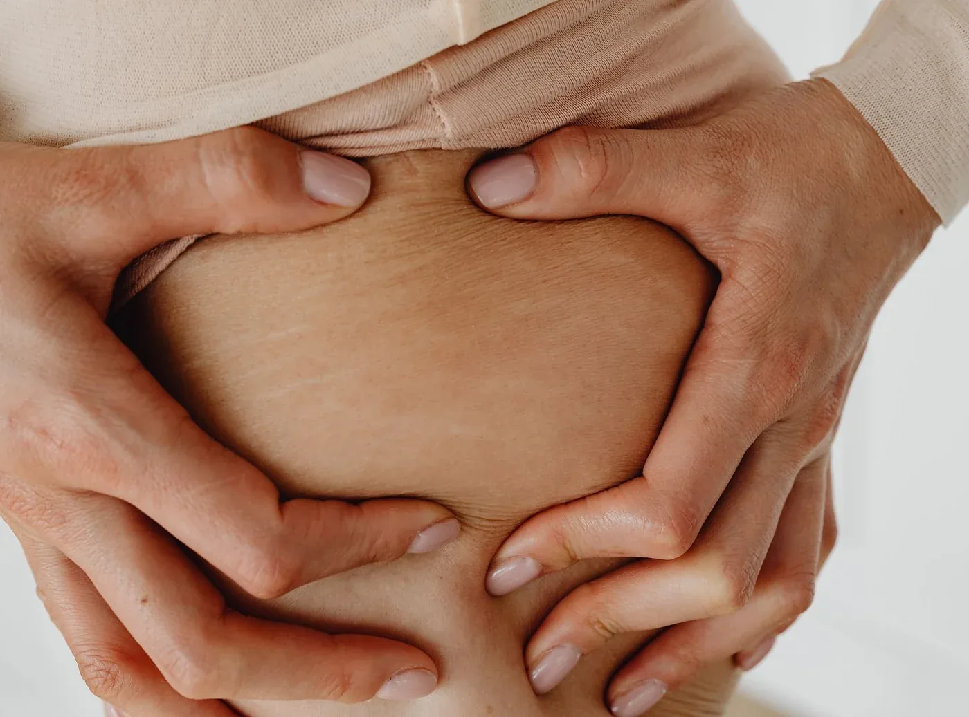 Close-up of stretch marks on a woman’s skin before treatment